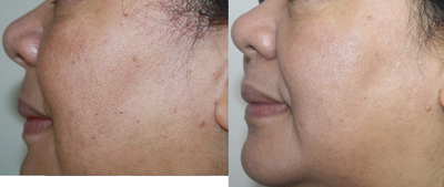 Chemical Peel before and after photo