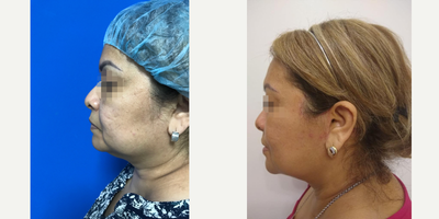 Chin Liposuction before and after photo