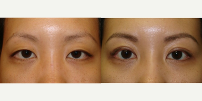 Double Eyelid Surgery before and after photo
