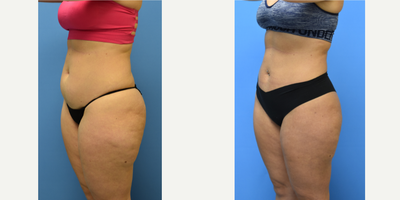 Liposuction before and after photo