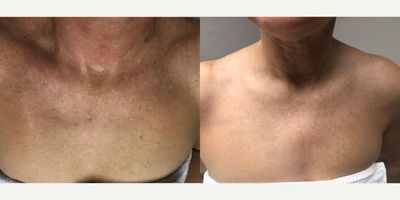 Skin Rejuvenation before and after photo