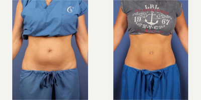 CoolSculpting before and after photo