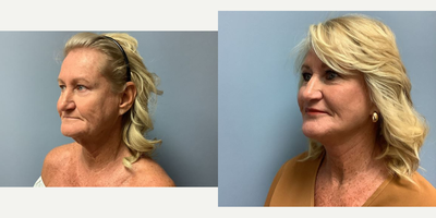 Facelift before and after photo