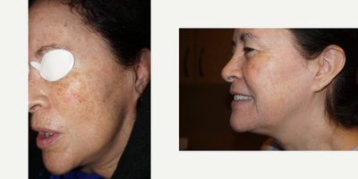 Laser Resurfacing before and after photo