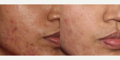 Laser Resurfacing before and after photo