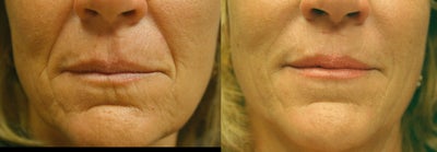 Lip Fillers before and after photo