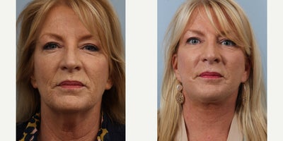 Lower Facelift before and after photo
