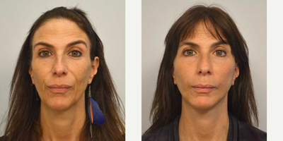 Mini Facelift before and after photo