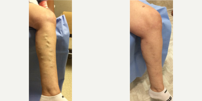 Sclerotherapy before and after photo