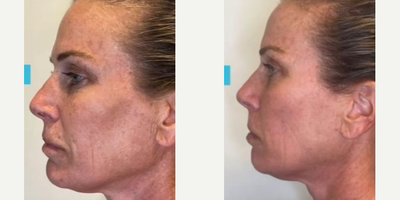 CO2 Laser before and after photo