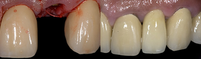 Dental Implants before and after photo