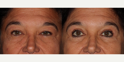 Eyelid Surgery before and after photo