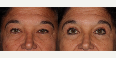Eyelid Surgery before and after photo