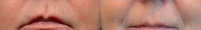 Belotero before and after photo