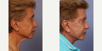 Facelift before and after photo