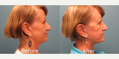 Facelift before and after photo