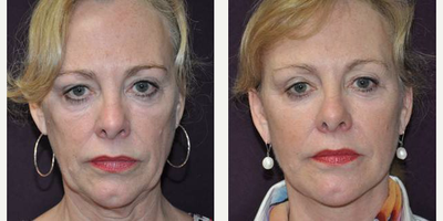 Facial Fat Transfer before and after photo