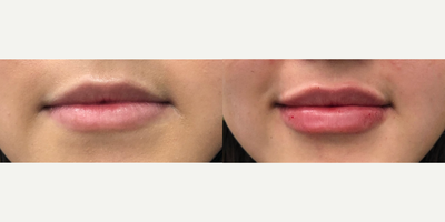 Lip Fillers before and after photo