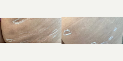 Qwo before and after photo