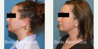 Renuvion before and after photo