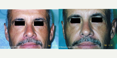 Restylane before and after photo