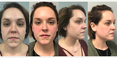CO2 Laser before and after photo