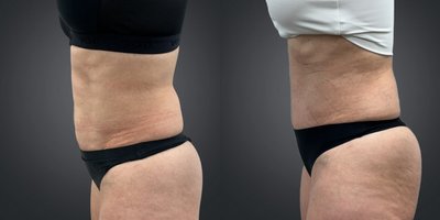 Diastasis Recti Repair before and after photo
