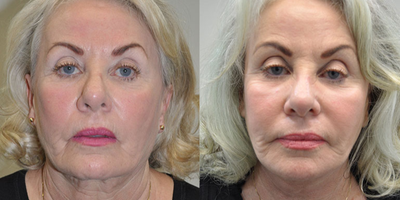 Facelift before and after photo