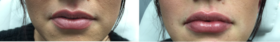 Juvederm before and after photo