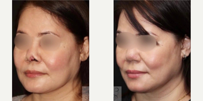 Revision Rhinoplasty before and after photo