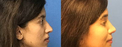 Rhinoplasty before and after photo
