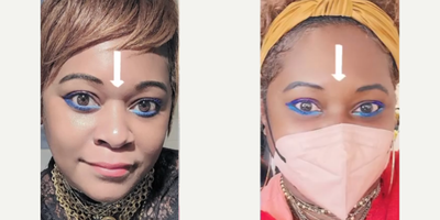 Botox before and after photo