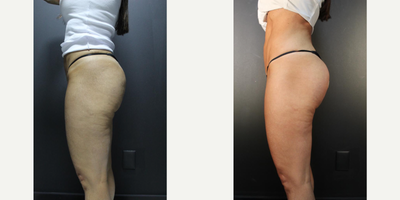 Nonsurgical Butt Lift before and after photo