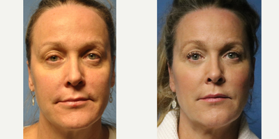 Bellafill before and after photo