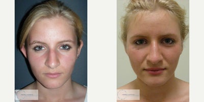 Ear Surgery before and after photo
