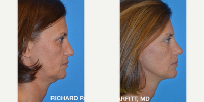 Facelift before and after photo