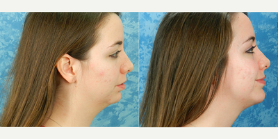 Genioplasty before and after photo