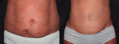 Tummy Tuck before and after photo