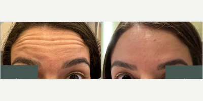 Botox before and after photo