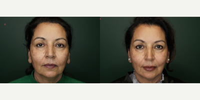 Chin Filler before and after photo