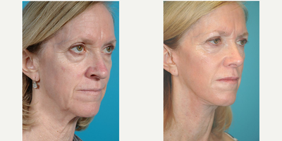 Facelift before and after photo