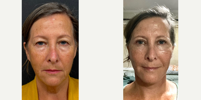 Facelift before and after photo