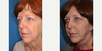 Neck Lift before and after photo