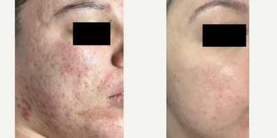 Sclerotherapy before and after photo