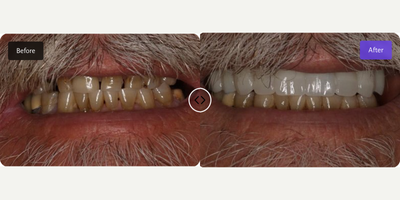 Smile Makeover before and after photo