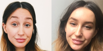 Botox before and after photo