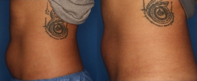 CoolSculpting before and after photo