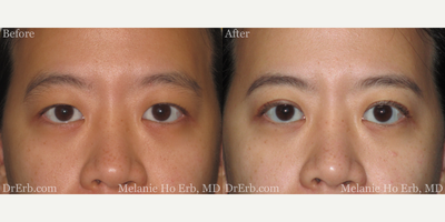 Double Eyelid Surgery before and after photo