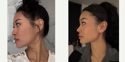 Revision Rhinoplasty before and after photo