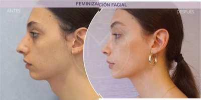 Transgender Facial Feminization Surgery before and after photo
